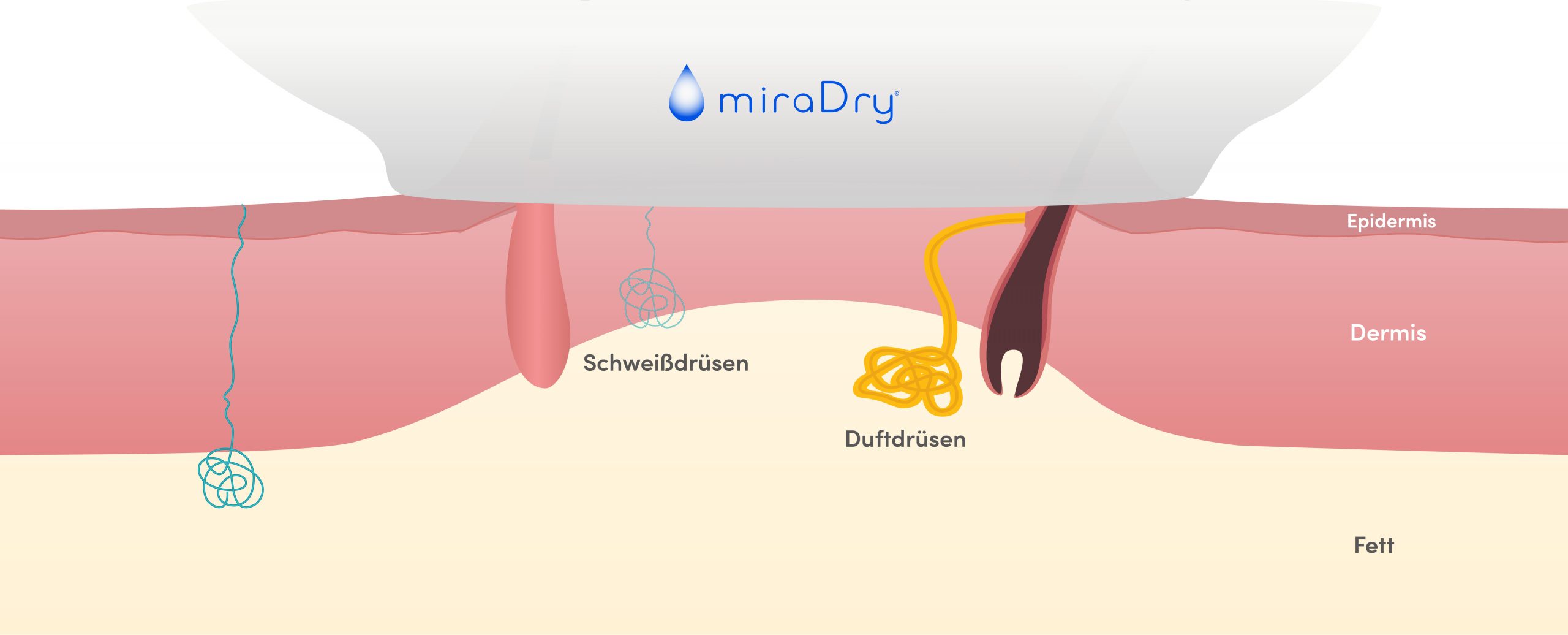Young Aesthetics miraDry Anti-Schweiß-Behandlung Hannover Hyperhidrose Achselschweiß Schritt 2